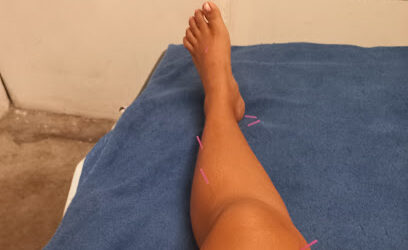 Quiropráctico y acupuntura CIMA, Acapulco